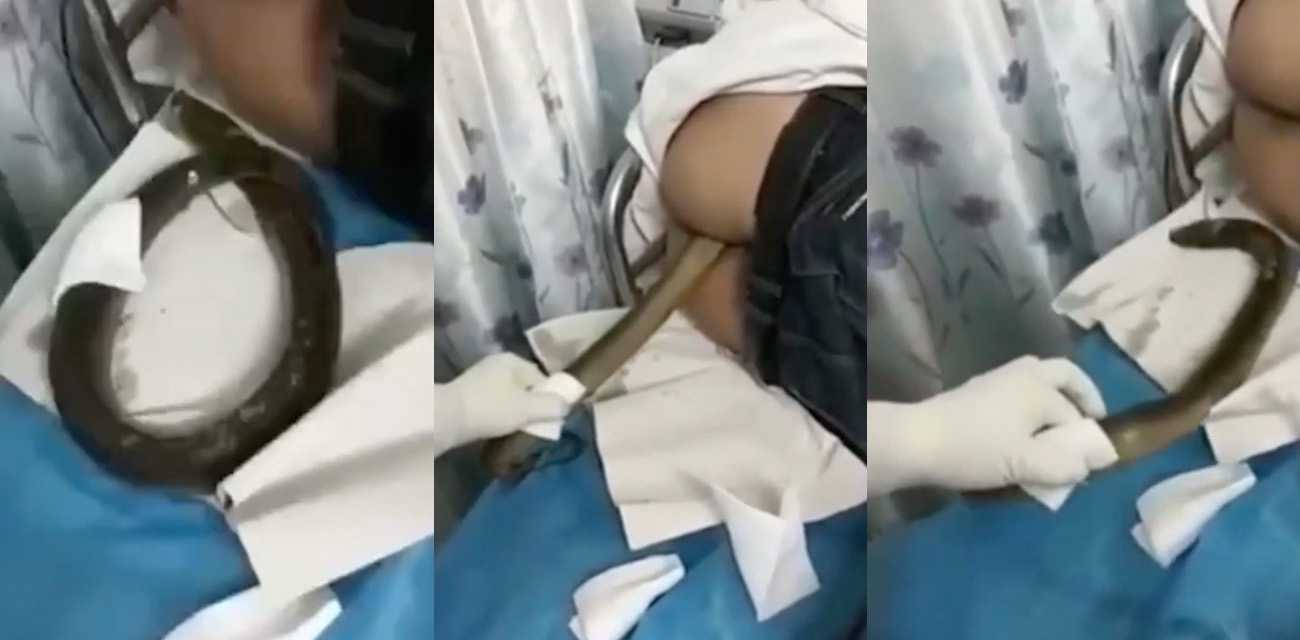 黄鳝入肛 一去不复返 无奈只能送到医院取出 惊呆了！