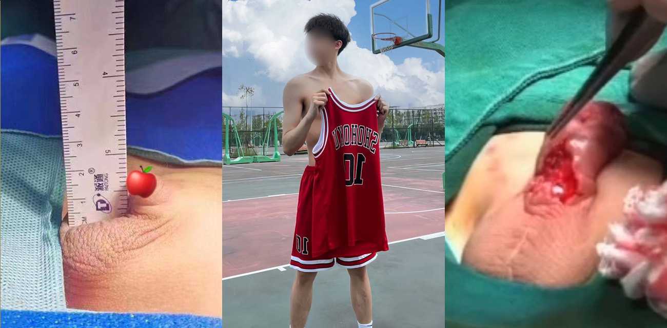 185大帅哥的阴茎增长手术 身高185腿长身材好 长得非常帅 但小鸡鸡只有2厘米